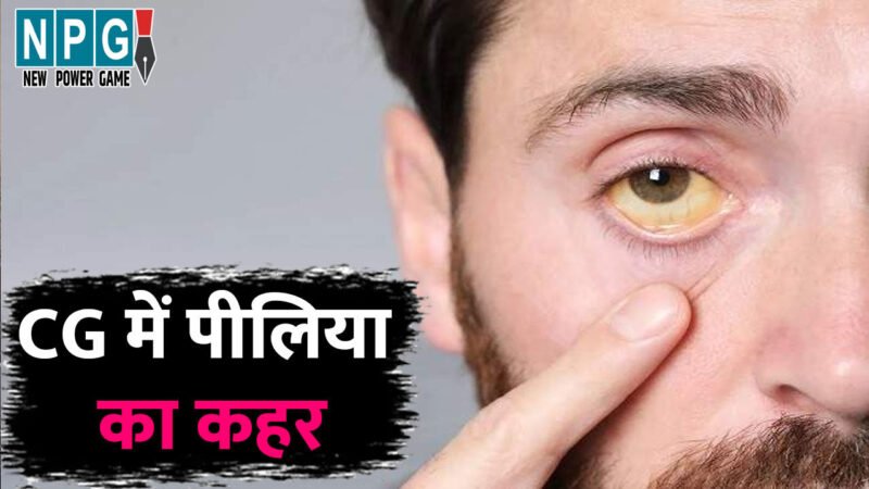 छत्तीसगढ़ में पीलिया का कहर: अंबिकापुर में मिले 42 मरीज,  स्वास्थ्य विभाग ने जारी की एडवाइजरी